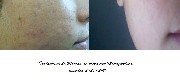 Tratamento de marcas de acne