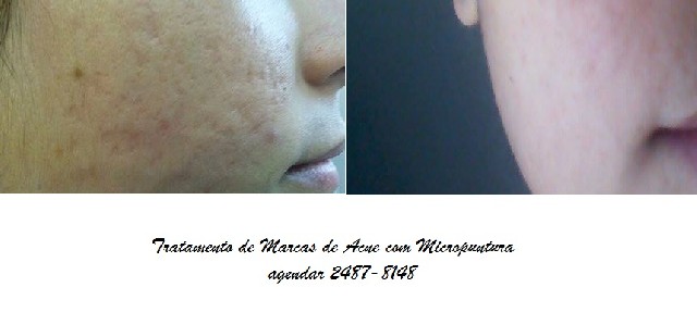 Foto 1 - Tratamento de marcas de acne